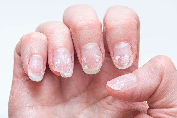 6 dấu hiệu trên móng tay cảnh báo vấn đề sức khỏe nghiêm trọng