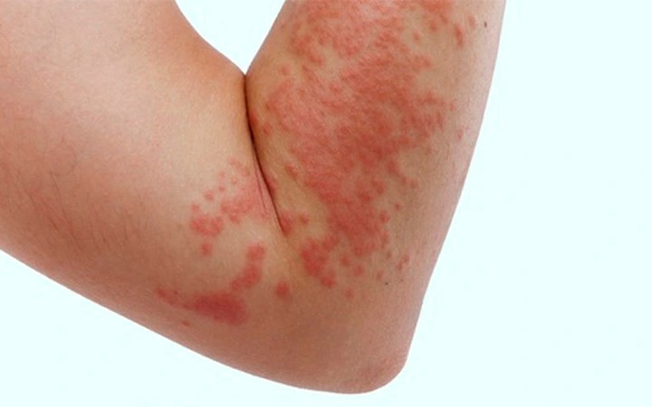 Dị ứng sulfa - Coi chừng biến chứng nguy hiểm